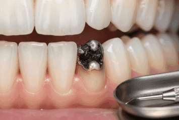 Can Stress Cause Cavities?