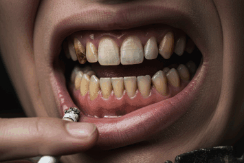 How Smoking Damages Your Teeth