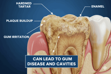 What Are Tartar and How Do They Form?