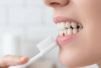 Why Do Gums Bleed When You Brush?
